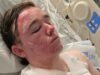 McDonald’s worker Jacob Smith suffers severe burns after coworker Jalani Bluett allegedly throws hot oil