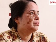 World Vitiligo Day: क्या छूने से फैलता है सफेद दाग? जानें इस मिथ की सच्चाई