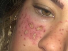 Influencer and TV personality Tilly Whitfield launches own line of tattoo freckle products after DIY horror