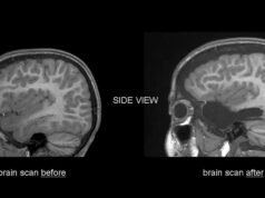 Aussie imaging agent to help brain cancer patients