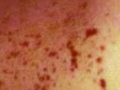 Second WA child hospitalised with meningococcal disease in two weeks as health authorities issue warning