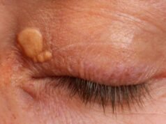 Yellow eye lumps linked to heart risk