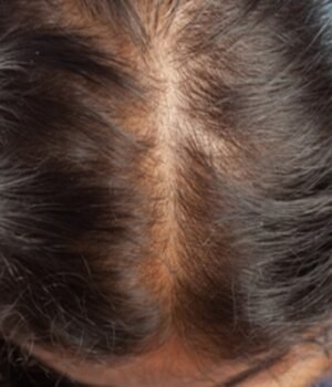 Hair_fall_1790350124254_fULN_1790350140106_SZkh_ea62229a-a0c5-4099-ba31-e86b3172caad_HWwW.jpg
