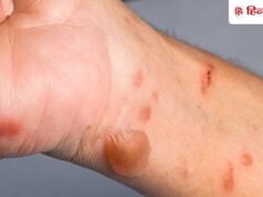 जल गए तो सबसे पहले क्या करें? डॉक्टर से जानें कौन से घरेलू नुस्खे ना आजमाएं