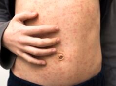 Armadale Hospital revealed as measles exposure site after WA child hospitalised with virus