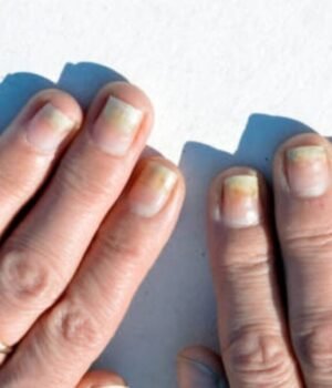 brittle_nails__1792836669830_SMLh_1792836670008_38L6_9b194ea5-62e2-4715-a3be-ff1bd0453bca_NCYv.jpg